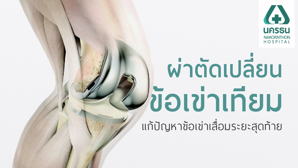 เปลี่ยนข้อเข่า เปลี่ยนข้อเข่า